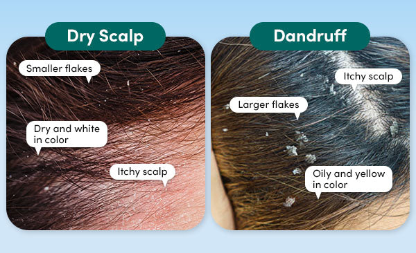 Dandruff vs Dry Scalp: What’s the Difference and How to Manage It?