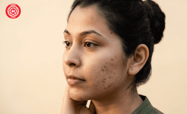 How to Treat Acne Scars: Causes, Prevention & Professional Treatment Options