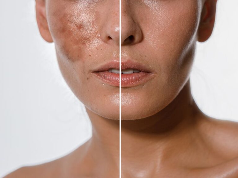 Chemical Peel for Pigmentation: How It Helps Dark Spots and Uneven Skin