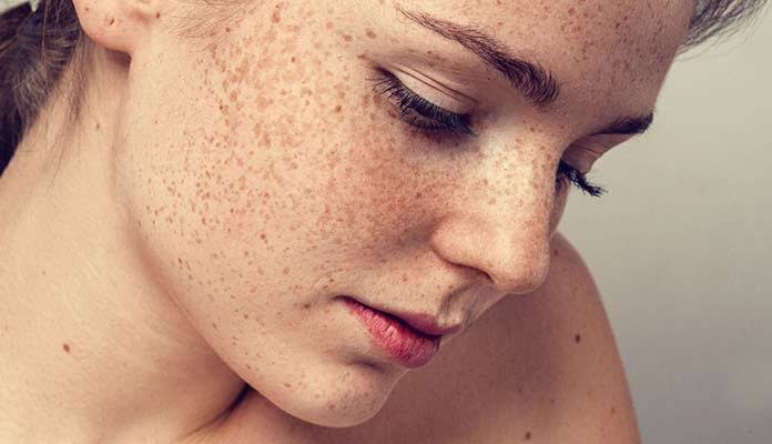 Melasma Treatment in Bramhapuri Causes, Symptoms & Treatment Options