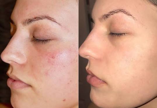 Chemical Peels for Uneven Skin Texture: What You Should Know
