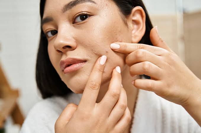 Post-Monsoon Skin Care Tips in Bramhapuri: Manage Acne, Pigmentation and Dullness